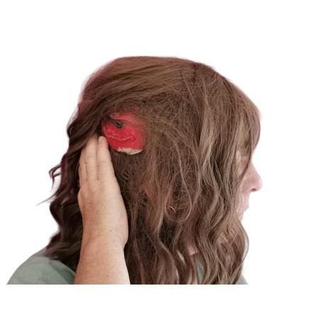 Perruque plaie cuir chevelu